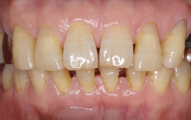 施術後の歯の状態