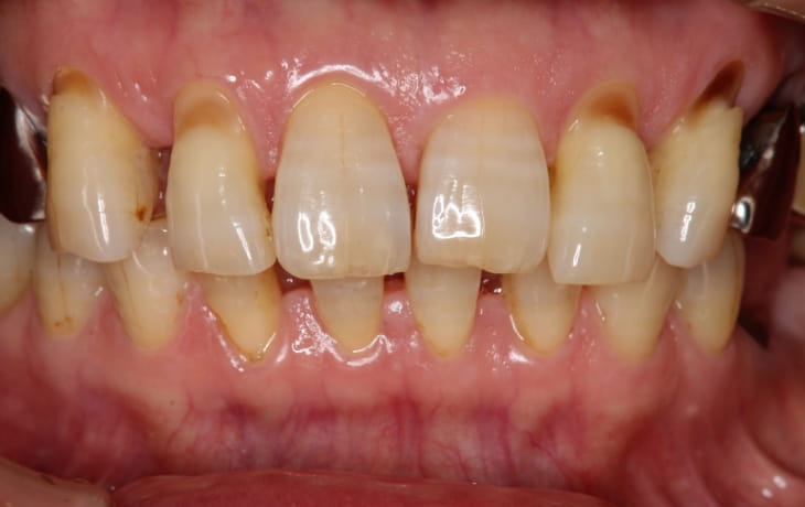 施術前の歯の状態