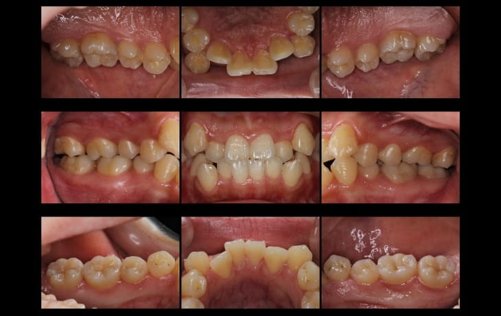 施術後の歯の状態