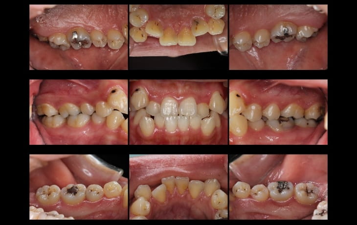 施術前の歯の状態