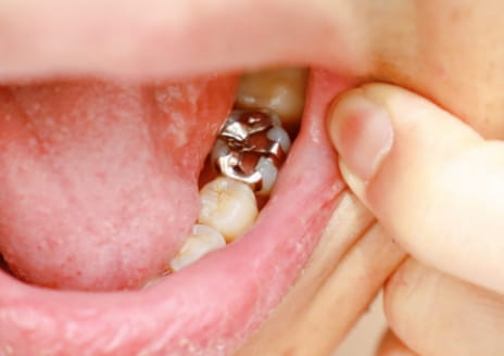 審美歯科のイメージ