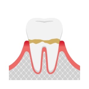 歯肉炎のイラスト。歯ぐきが赤く腫れ、歯石が付着している状態