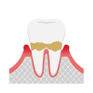 軽度歯周炎のイラスト。歯ぐきが赤く腫れ、歯石が溜まっている状態