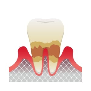 中等度歯周炎のイラスト。歯槽骨が溶け、歯ぐきが赤く腫れ後退している状態