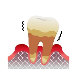 重度歯周炎のイラスト。歯のぐらつき、歯槽骨の吸収、激しい歯ぐきの腫れ