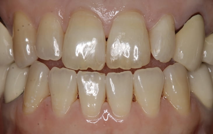 施術後の歯の状態