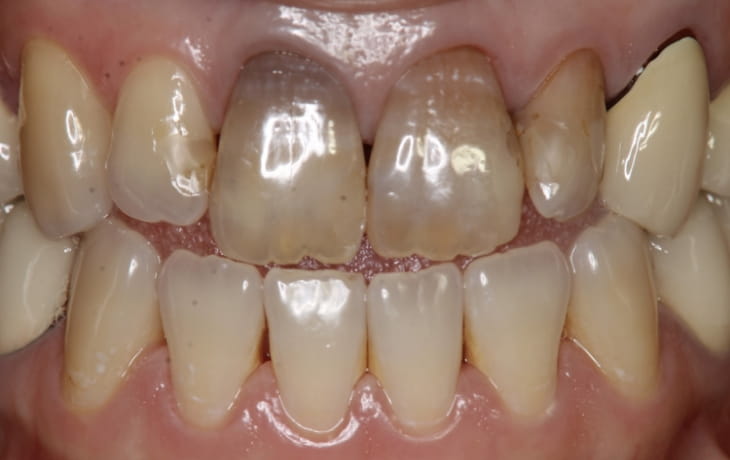 施術前の歯の状態